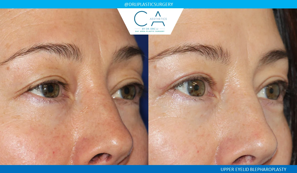 1 – Upper Eyelid Surgery Oblique