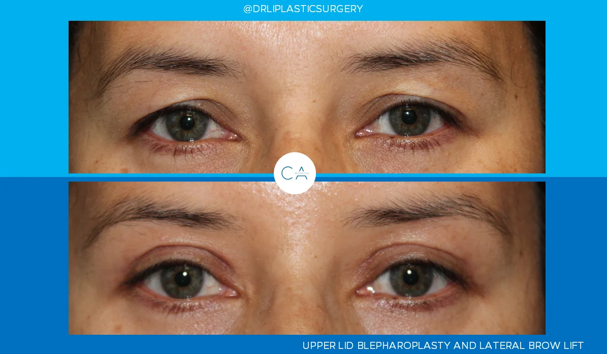 1 – Upper Eyelid Surgery and Browlift AP