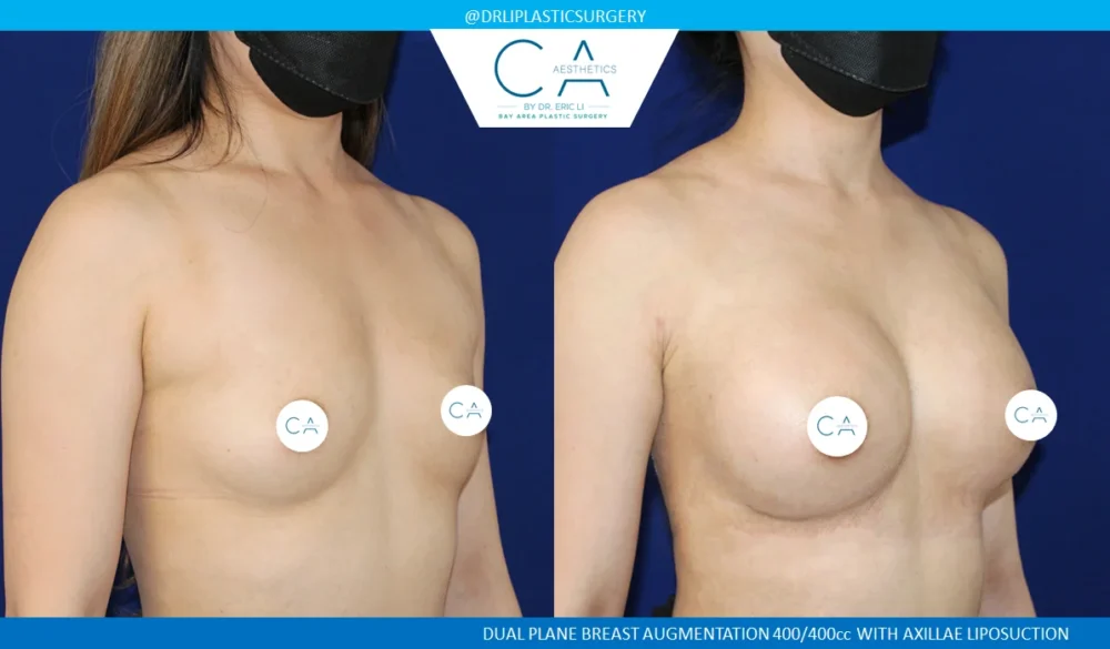 Breast Augmentation case #5224