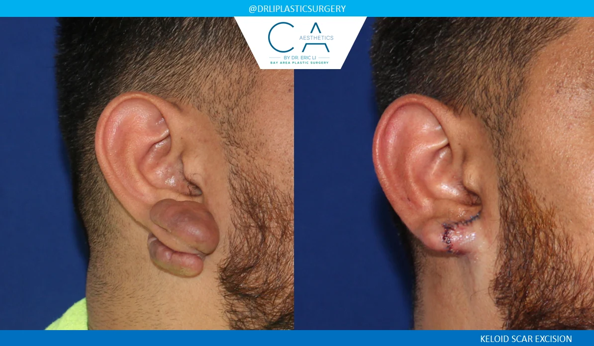 10 – Keloid Scar Excision