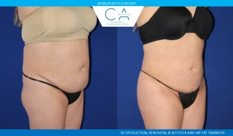 360 Liposuction (Torso) case #5519