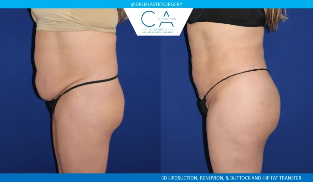 360 Liposuction (Torso) case #5519