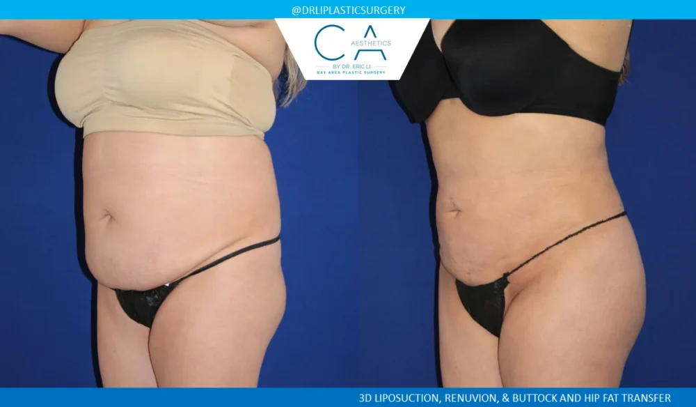 360 Liposuction (Torso) case #5519