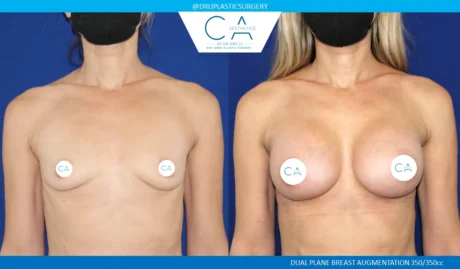 Breast Augmentation case #5223