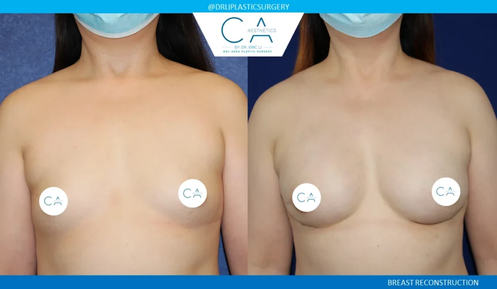 Breast Reconstruction case #5349