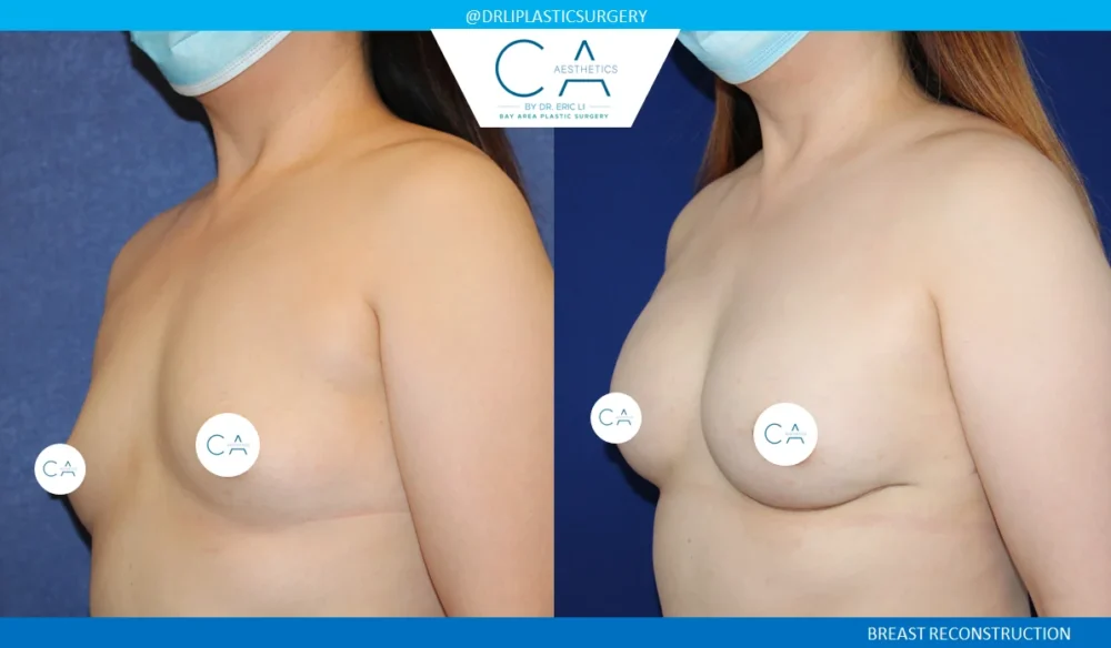 Breast Reconstruction case #5349