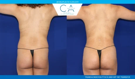 360 Liposuction (Torso) case #5518