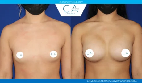 Breast Augmentation case #5222