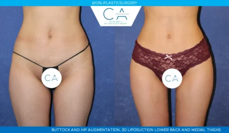 360 Liposuction (Torso) case #5517