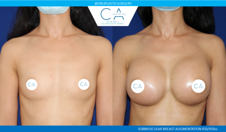 Breast Augmentation case #5221