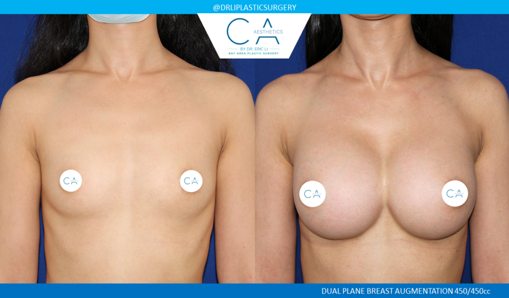Breast Augmentation case #5221