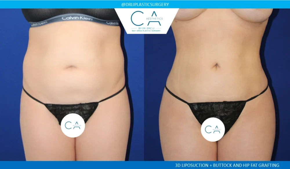 360 Liposuction (Torso) case #5516