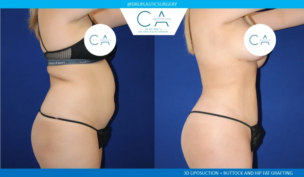 360 Liposuction (Torso) case #5516