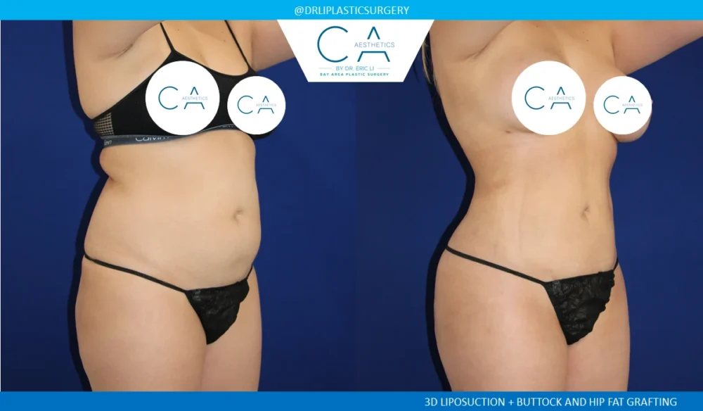 360 Liposuction (Torso) case #5516