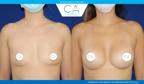 Breast Augmentation case #5220