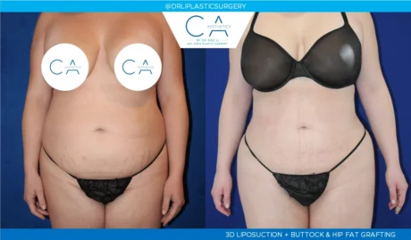 360 Liposuction (Torso) case #5515