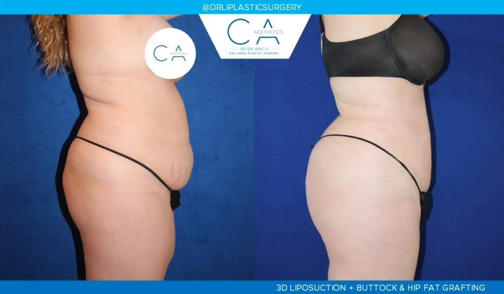 360 Liposuction (Torso) case #5515