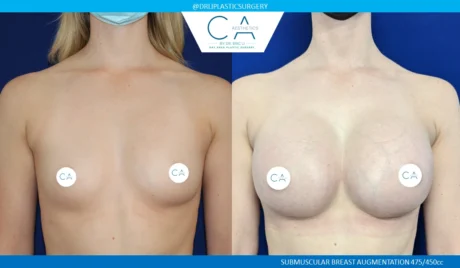 Breast Augmentation case #5219