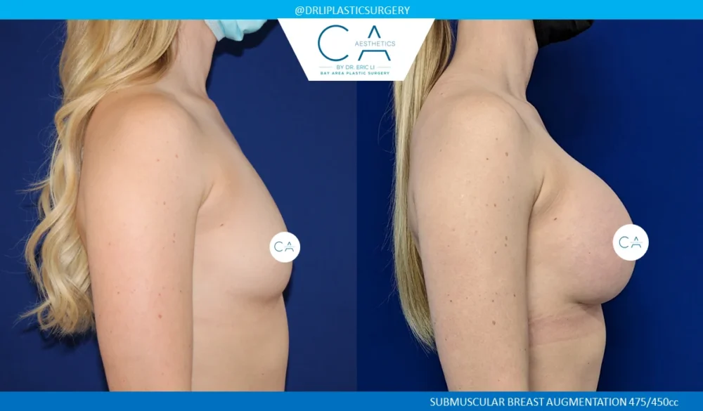 Breast Augmentation case #5219