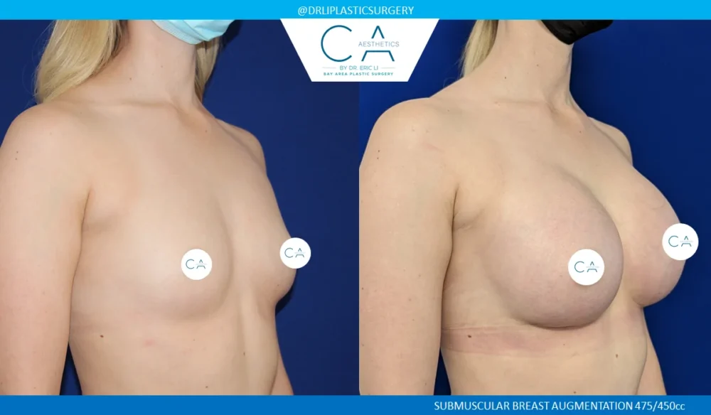 Breast Augmentation case #5219