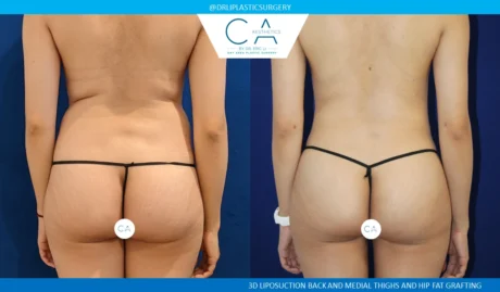 360 Liposuction (Torso) case #5514