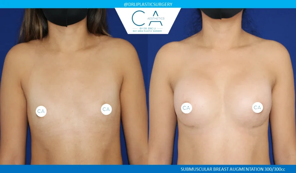 Breast Augmentation case #5218