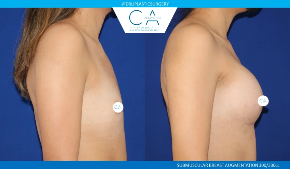 Breast Augmentation case #5218