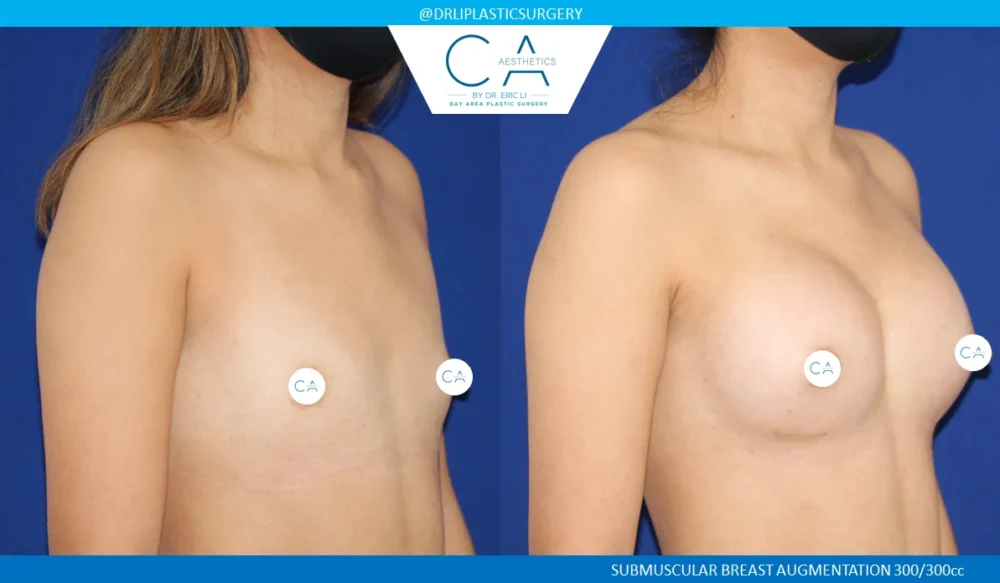 Breast Augmentation case #5218