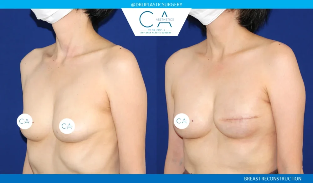 Breast Reconstruction case #5344