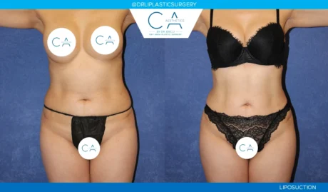 360 Liposuction (Torso) case #5513