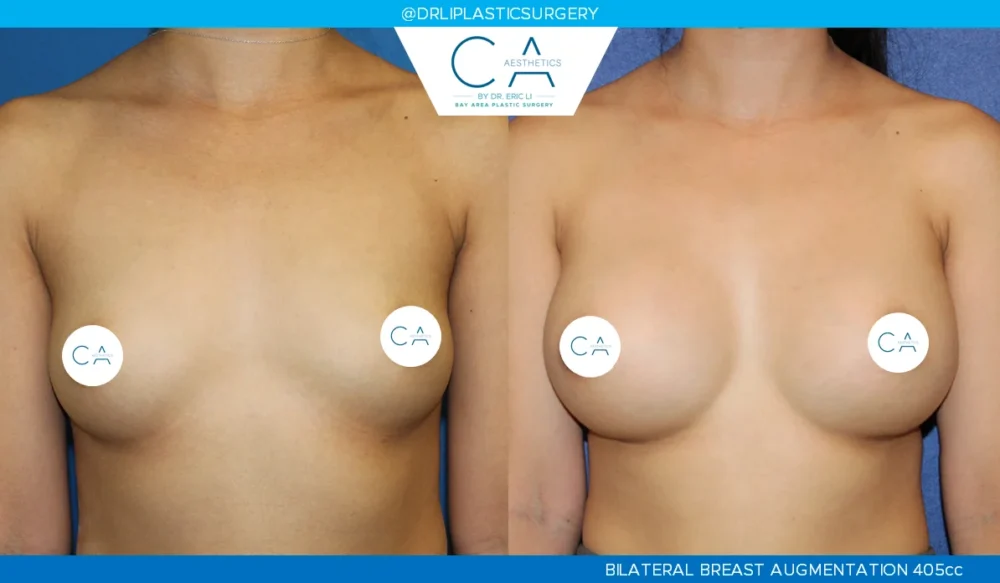 Breast Augmentation case #5217