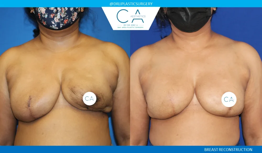 Breast Reconstruction case #5343