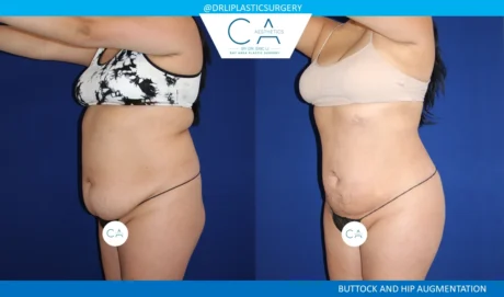 360 Liposuction (Torso) case #5512