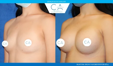 Breast Augmentation case #5216