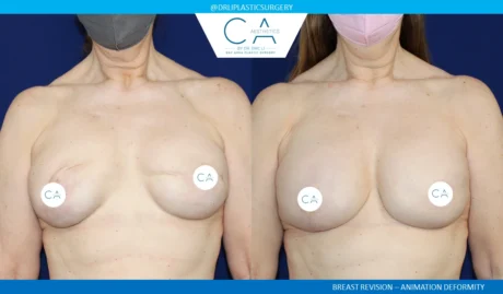 Breast Reconstruction case #5342