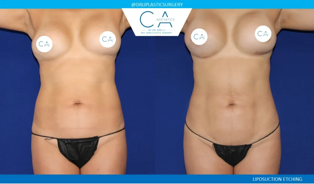 360 Liposuction (Torso) case #5511