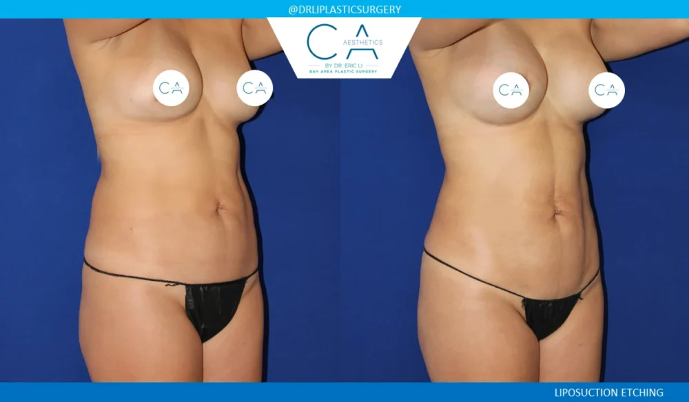 360 Liposuction (Torso) case #5511