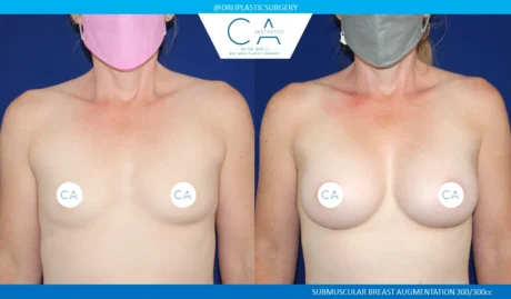 Breast Augmentation case #5215