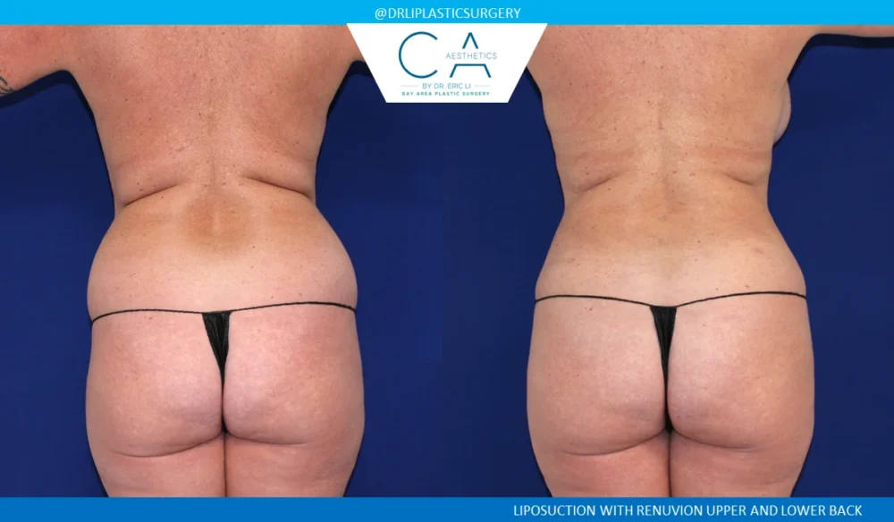 360 Liposuction (Torso) case #5510