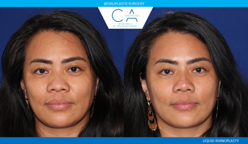 Fillers case #5052