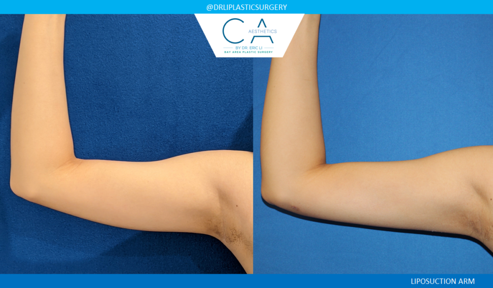 Arm Liposuction case #4570