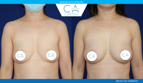 Fat Transfer Breast Augmentation case #4861