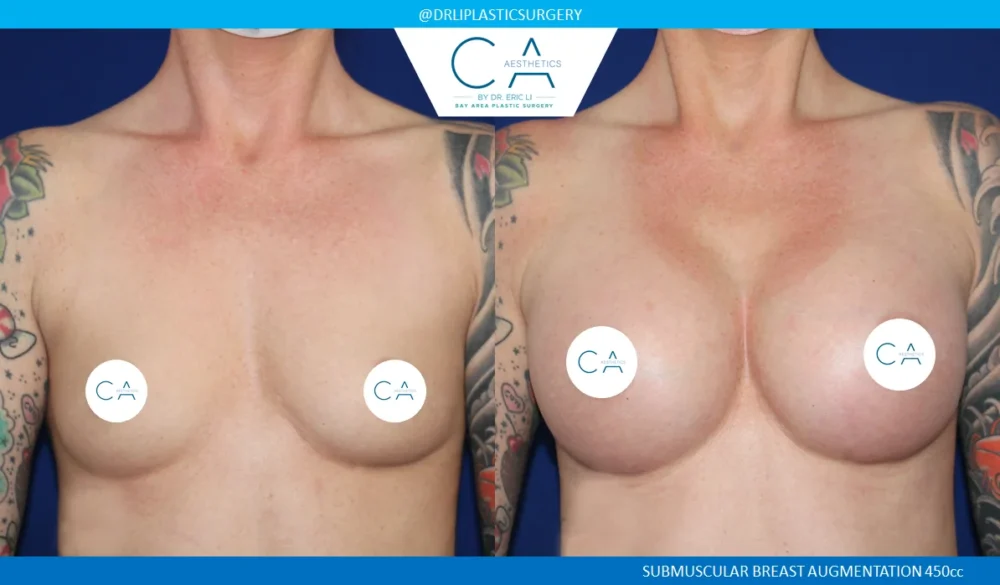 Breast Augmentation case #5232