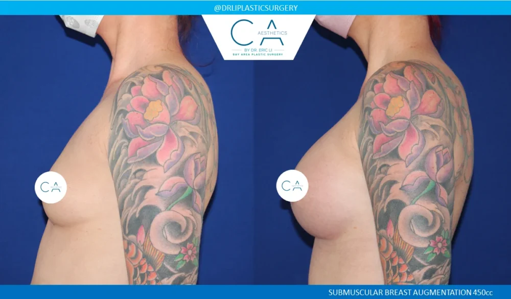 Breast Augmentation case #5232