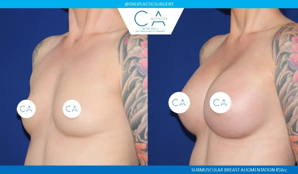 Breast Augmentation case #5232