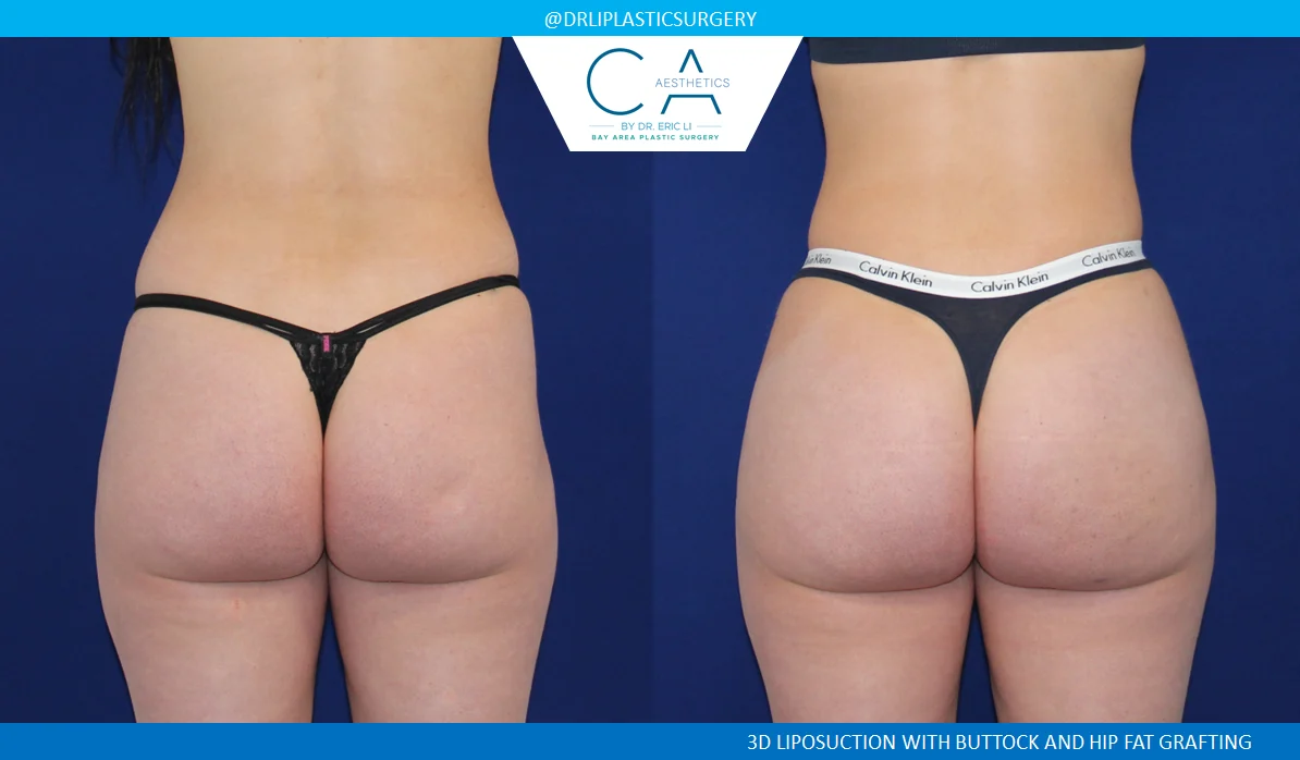 2 – Buttock Augmentation AP