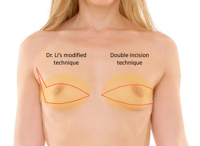 Female to Male Top Surgery case #4875