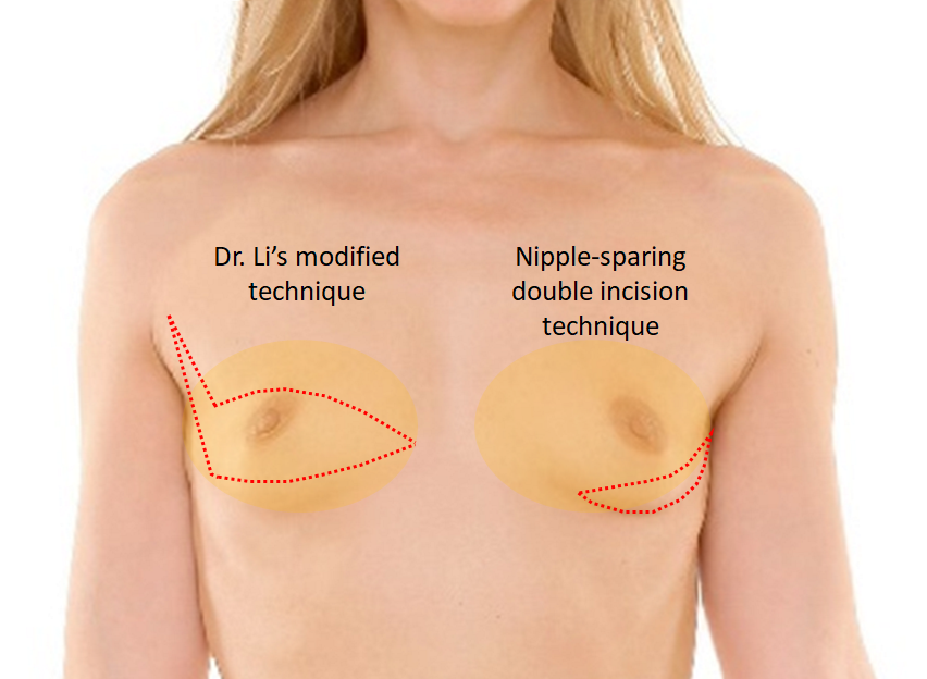 Female to Male Top Surgery case #4875