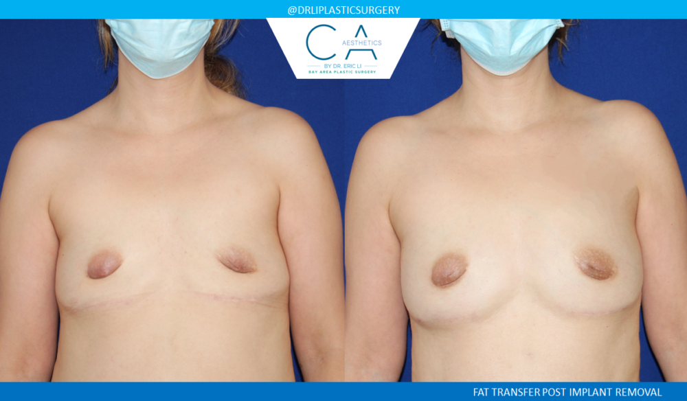 Breast Implant Removal case #4935