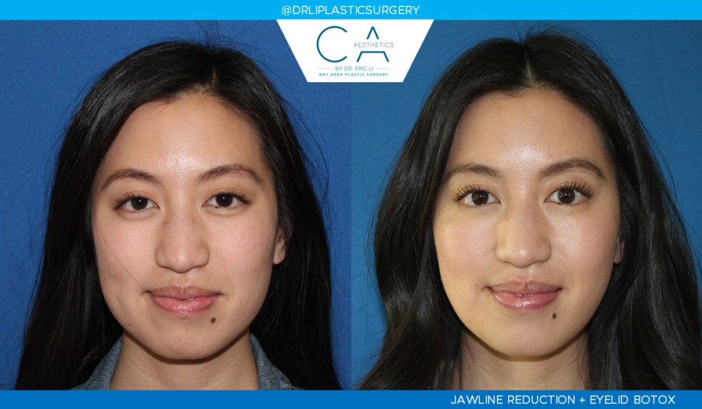 Jawline Reduction case #4745